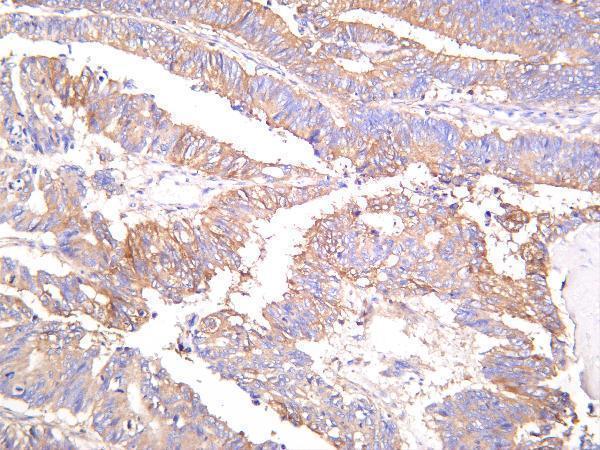Human colon carcinoma was stained with Anti-Optineurin rabbit antibody