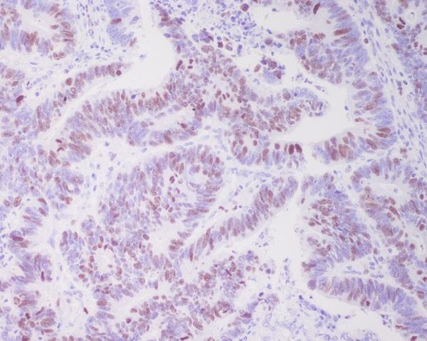 Immunohistochemical analysis of paraffin-embedded human colon cancer, using Topoisomerase II alpha Antibody