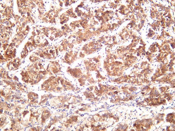 Human hepatocellular carcinoma was stained with anti-GRP78/BiP rabbit antibody
