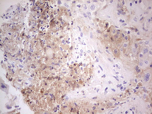 Immunohistochemical staining of paraffin-embedded Carcinoma of Human lung tissue using anti-CFI mouse monoclonal antibody