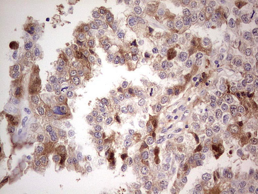 Immunohistochemical staining of paraffin-embedded Adenocarcinoma of Human ovary tissue using anti-CFI mouse monoclonal antibody