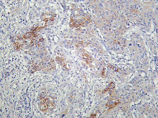 Human cervical carcinoma was stained with Anti-AMPK α1 rabbit antibody