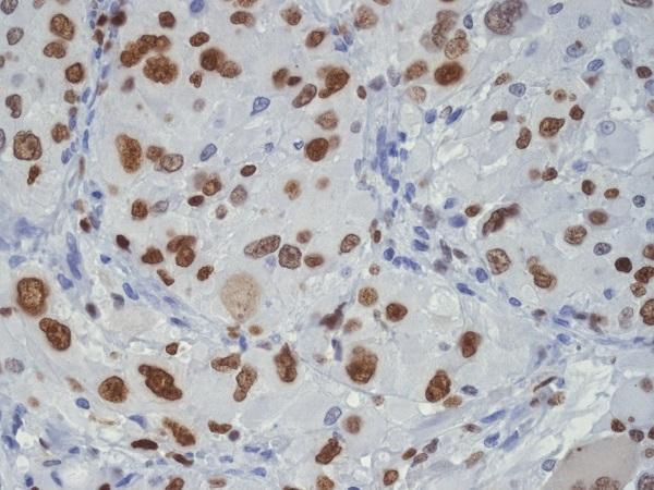 Immunohistochemical analysis of paraffin-embedded human glioma, using TDP43 Antibody