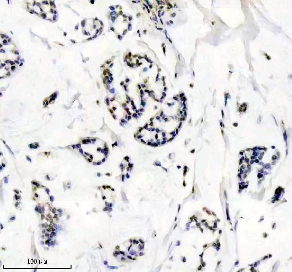 IHC analysis of MGMT using anti-MGMT antibody (M01012)