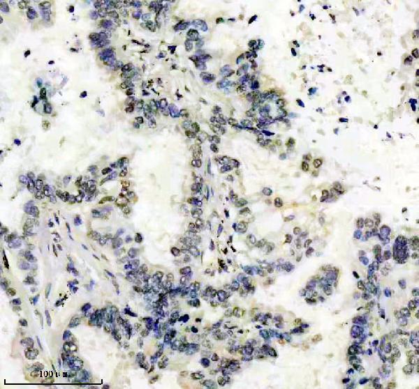 IHC analysis of MGMT using anti-MGMT antibody (M01012)