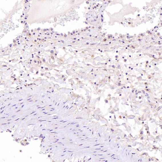 Immunohistochemical analysis of paraffin-embedded Human liver cancer, using the Antibody at 1:500 dilution