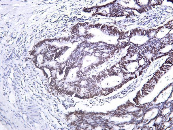 Human rectal carcinoma tissue was stained with anti-PMS2 rabbit Antibody