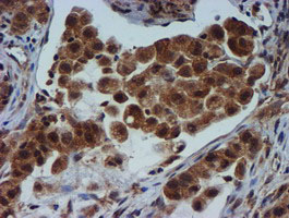 Immunohistochemical staining of paraffin-embedded Carcinoma of Human lung tissue using anti-TIMP2 mouse monoclonal antibody