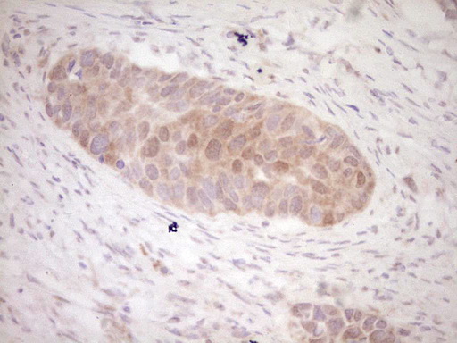 Immunohistochemical staining of paraffin-embedded Carcinoma of Human kidney tissue using anti-KLF2 mouse monoclonal antibody