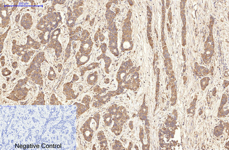 Immunohistochemical analysis of paraffin-embedded Human-liver-cancer tissue