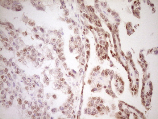 Immunohistochemical staining of paraffin-embedded Adenocarcinoma of Human ovary tissue using anti-TFPI mouse monoclonal antibody