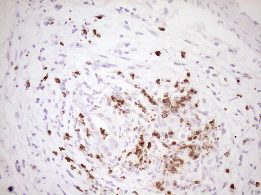 Immunohistochemical staining of paraffin-embedded Carcinoma of Human pancreas tissue using anti-TFPI mouse monoclonal antibody