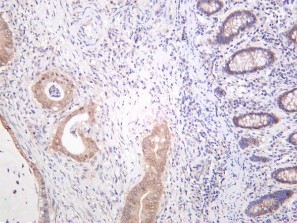 Human colon carcinoma was stained with anti-p90RSK (phospho Thr359/Ser363) rabbit antibody