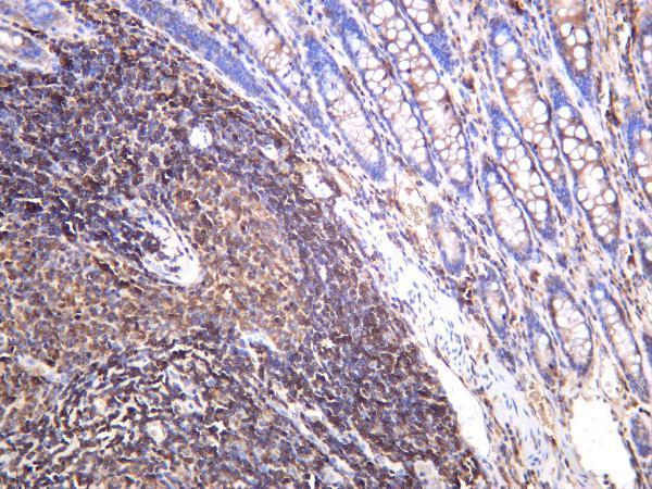 Human colon carcinoma was stained with anti-p90RSK (phospho Ser380) rabbit antibody