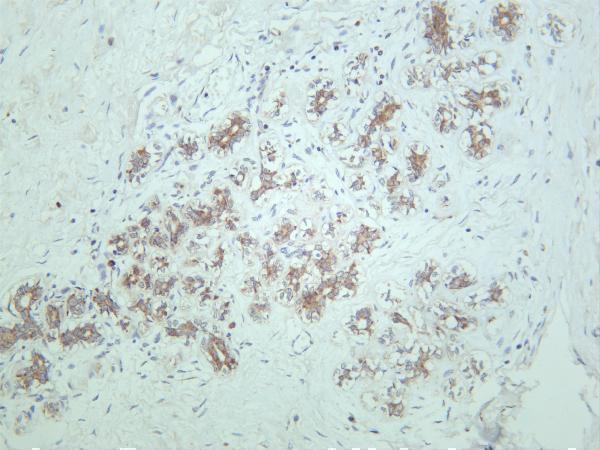 Human breast carcinoma was stained with anti-p90RSK rabbit antibody