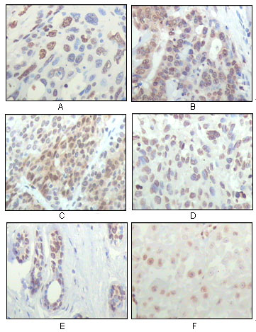 Immunohistochemistry analysis of paraffin-embedded human esophageal squamous cell carcinoma (A), colon adenocarcinoma (B), liver carcinoma (C), skin carcinoma (D), breast ductal tumor (E) and brain tumor (F), showing nuclear localization with DAB staining