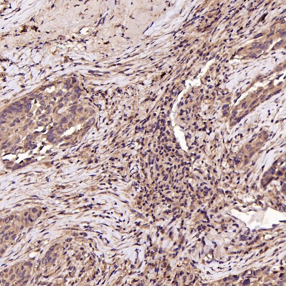 Immunohistochemical analysis of paraffin-embedded Human squamous carcinoma, using the Antibody at 1:50 dilution
