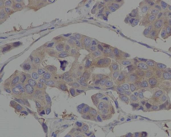 Immunohistochemical analysis of paraffin-embedded human breast cancer, using Hsp90 alpha antibody