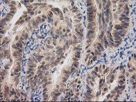 Immunohistochemical staining of paraffin-embedded Carcinoma of Human lung tissue using anti-RASSF1 mouse monoclonal antibody