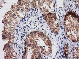 Immunohistochemical staining of paraffin-embedded Adenocarcinoma of Human ovary tissue using anti-RASSF1 mouse monoclonal antibody