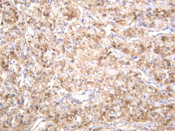 Human hepatocellular carcinoma was stained with anti-Arginase-1 rabbit antibody