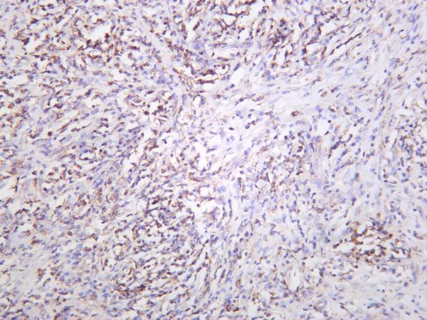 Human thyroid carcinoma was stained with anti-mtTFA rabbit antibody