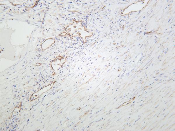 Human lung squamous carcinoma was stained with anti-Podoplanin rabbit antibody