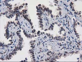 Immunohistochemical staining of paraffin-embedded Carcinoma of Human lung tissue using anti-MEF2C mouse monoclonal antibody