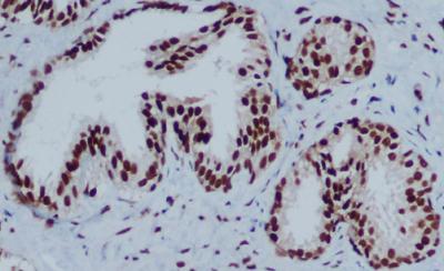 Immunohistochemical analysis of paraffin-embedded Prostate Cancer using CBX3 mouse mAb (1/200 dilution)