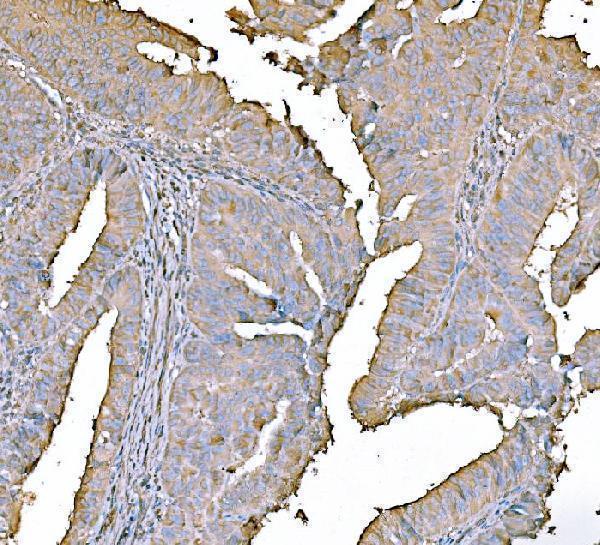  IHC analysis of PKM2 using anti-PKM2 antibody (M01173-1)