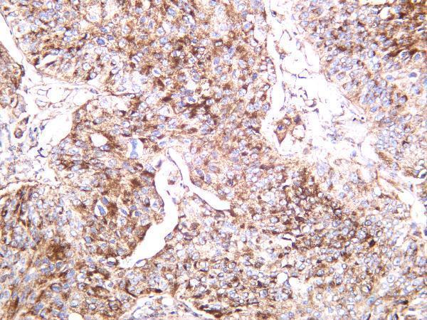 Human bladder carcinoma was stained with anti-CD9 rabbit antibody