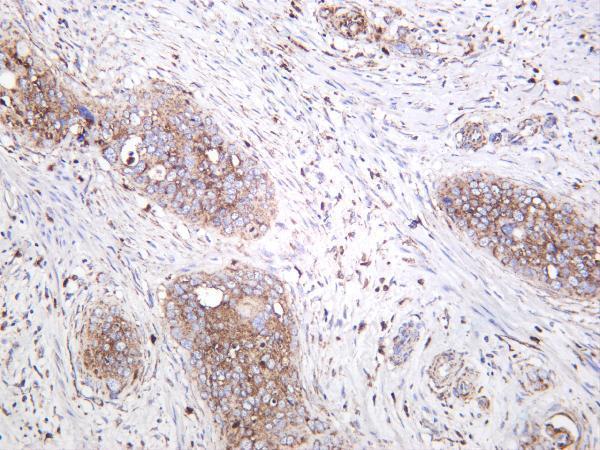 Human cervical carcinoma was stained with anti-CD9 rabbit antibody