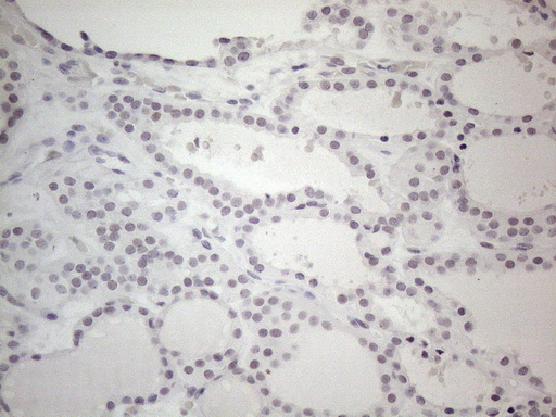 Immunohistochemical staining of paraffin-embedded Human thyroid tissue within the normal limits using anti-TDG mouse monoclonal antibody