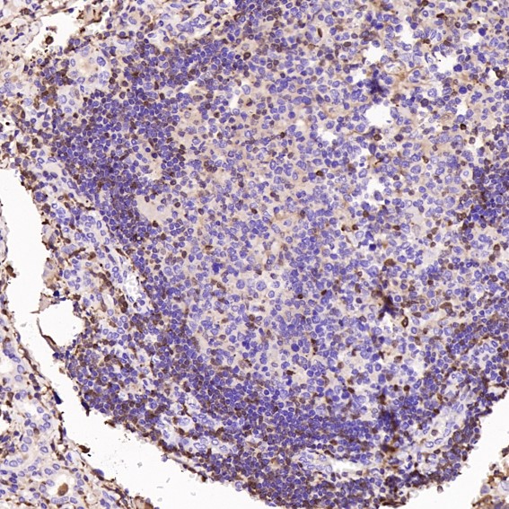 Immunohistochemical analysis of paraffin-embedded Human thyroid cancer, using the Antibody at 1:500 dilution