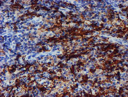 Immunohistochemical staining of paraffin-embedded Human lymphoma tissue using anti-ALOX15 mouse monoclonal antibody