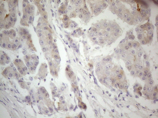 Immunohistochemical staining of paraffin-embedded Carcinoma of Human liver tissue using anti-F12 mouse monoclonal antibody