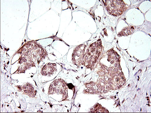 Immunohistochemical staining of paraffin-embedded Adenocarcinoma of Human breast tissue using anti-APOA5 mouse monoclonal antibody