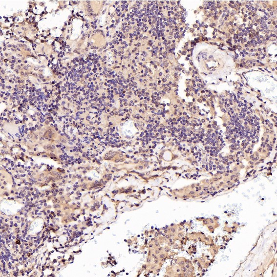 Immunohistochemical analysis of paraffin-embedded Human thyroid cancer, using the Antibody at 1:50 dilution