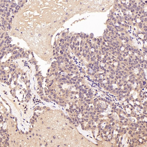 Immunohistochemical analysis of paraffin-embedded Human ovarian cancer, using the Antibody at 1:50 dilution