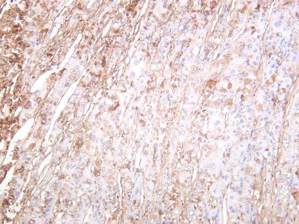 Human hepatocellular carcinoma was stained with anti-Albumin rabbit antibody