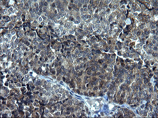 Immunohistochemical staining of paraffin-embedded Adenocarcinoma of Human endometrium tissue using anti-KITLG mouse monoclonal antibody