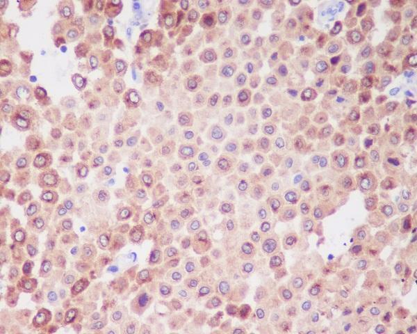 Immunohistochemical analysis of paraffin-embedded human melanoma, using PMEL17 / GP100 Antibody