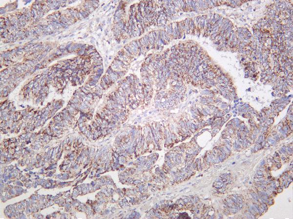 Human colon carcinoma was stained with Anti-Glutaminase C rabbit antibody