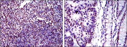 Immunohistochemistry analysis of paraffin-embedded human tonsil tissues (left) and human colon cancer tissues (right) with DAB staining using Ku-80 Monoclonal Antibody
