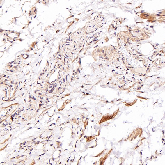 Immunohistochemical analysis of paraffin-embedded Human testis cancer, using the Antibody at 1:400 dilution.