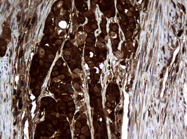 Immunohistochemical staining of paraffin-embedded Adenocarcinoma of Human colon tissue using anti-NME1 mouse monoclonal antibody