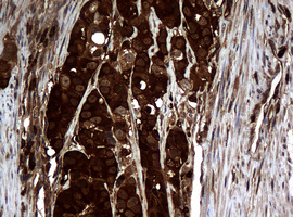 Immunohistochemical staining of paraffin-embedded Carcinoma of Human liver tissue using anti-NME1 mouse monoclonal antibody