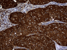 Immunohistochemical staining of paraffin-embedded Adenocarcinoma of Human ovary tissue using anti-NME1 mouse monoclonal antibody