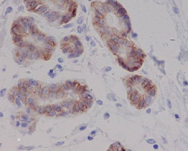 Immunohistochemical analysis of paraffin-embedded human breast cancer, using c-Kit Antibody 