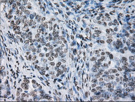 Immunohistochemical staining of paraffin-embedded Adenocarcinoma of Human ovary tissue using anti-ID3 mouse monoclonal antibody